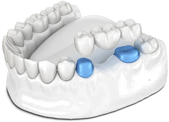 Dental Crown Restoration