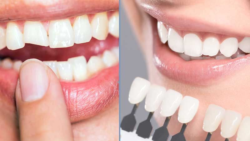 Dental Crown Procedure