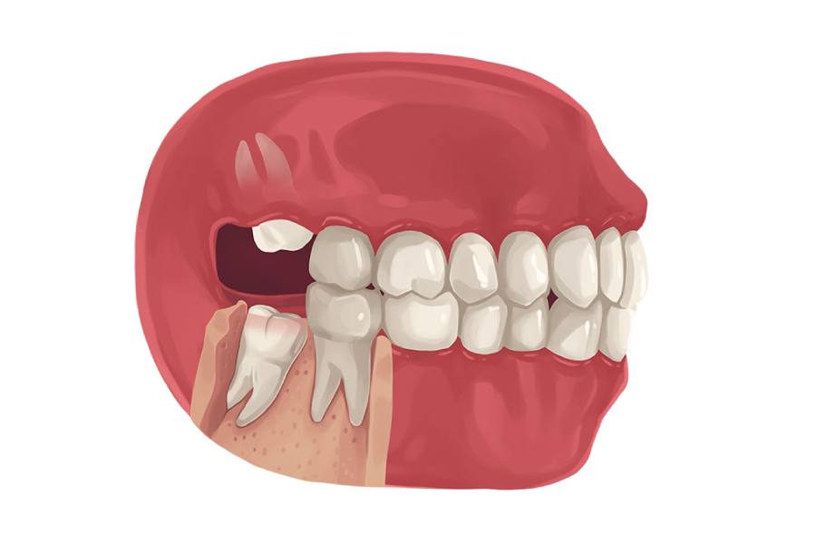 Wisdom Tooth Signs