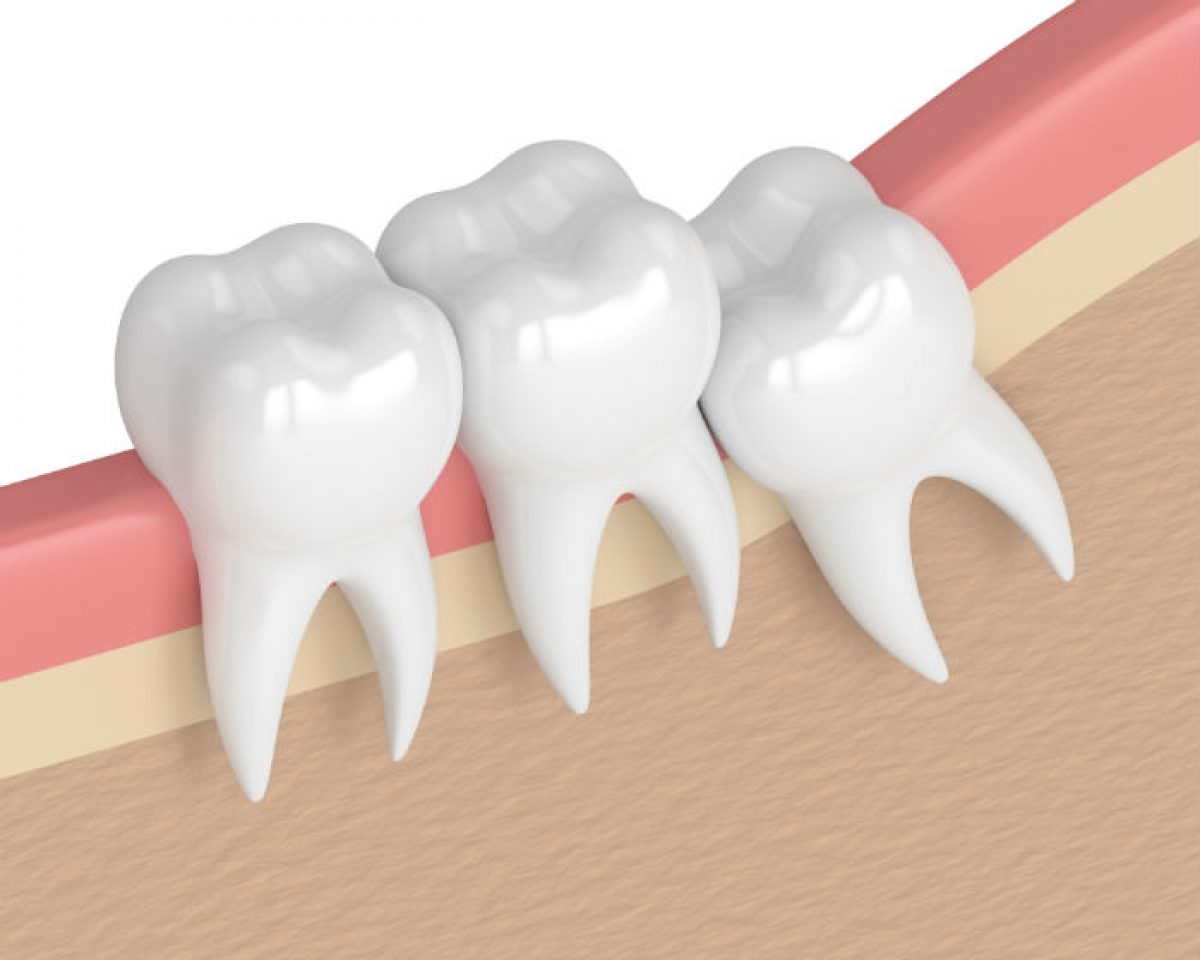 Benefits of Wisdom Tooth Removal