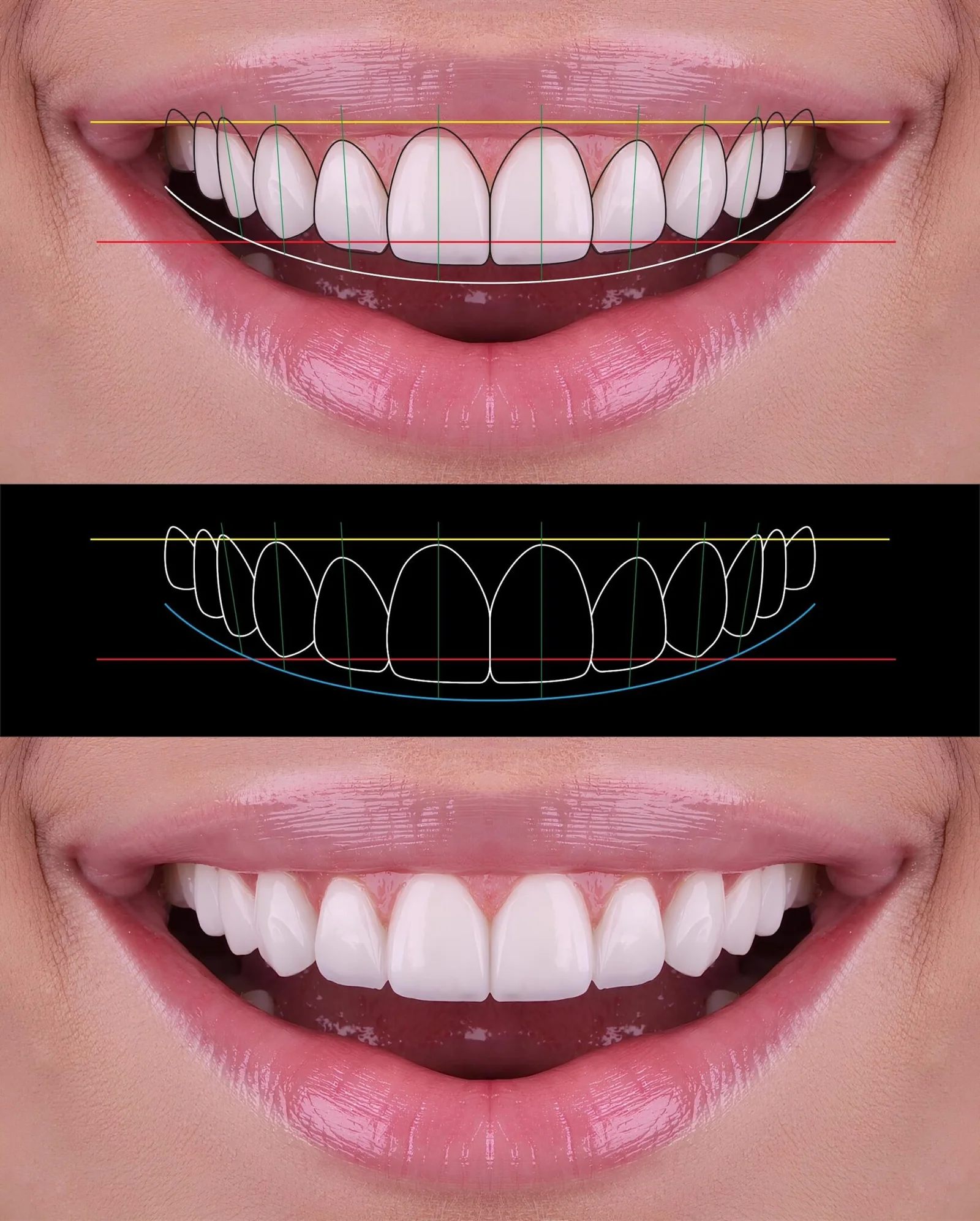 Full Mouth Reconstruction Process