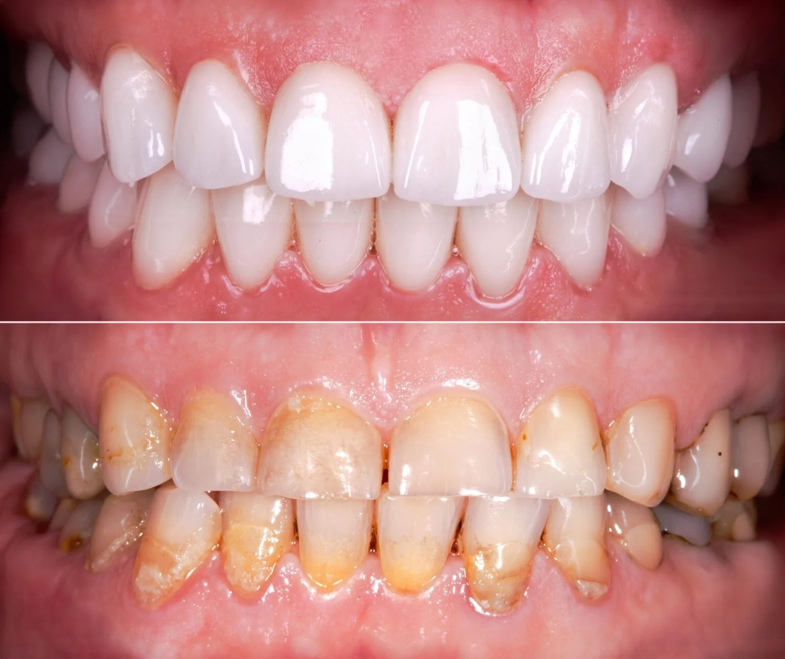 Full Mouth Reconstruction Candidate