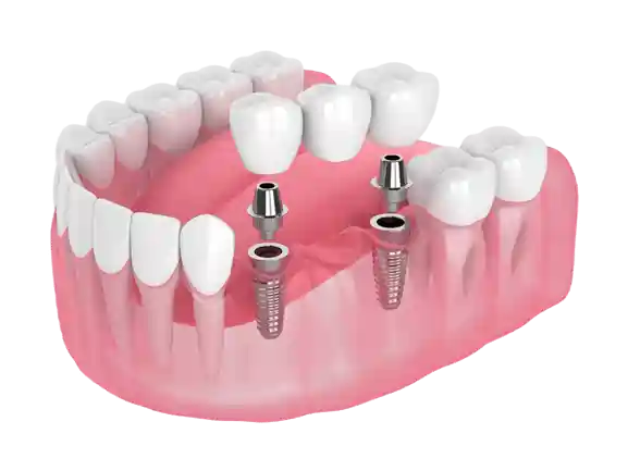 Same-Day Dental Implants