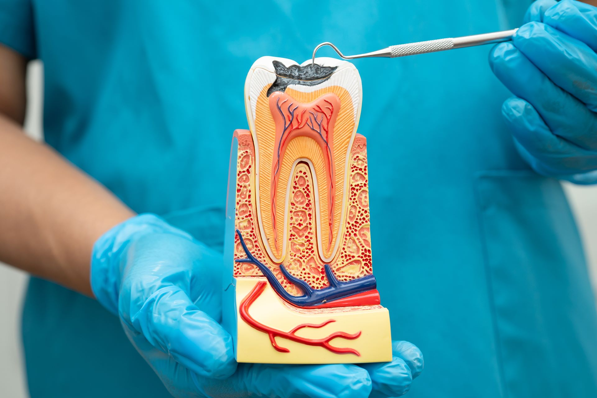 Root Canal Treatment
