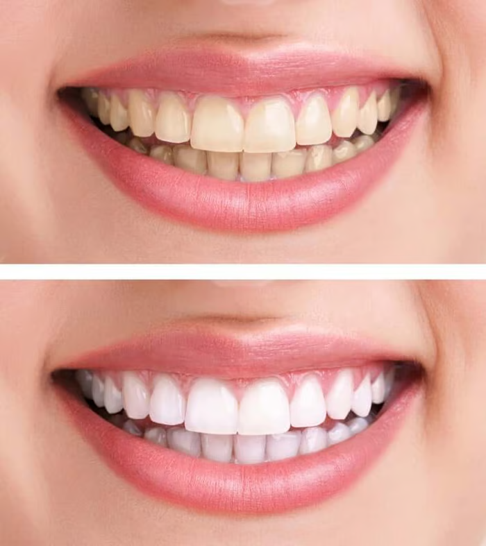 Porcelain Dental Veneers