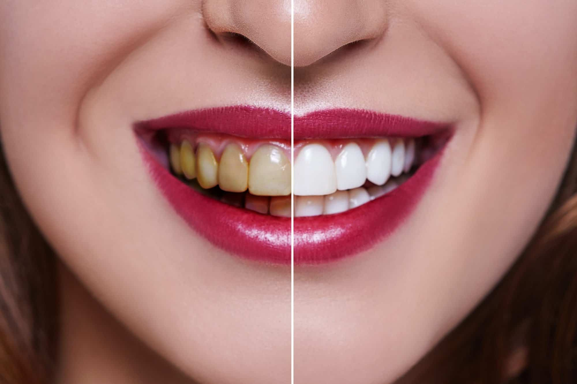 Teeth Whitening Candidate